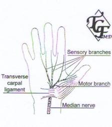 Carpal Tunne Syndrome