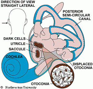 bppv-otoconia-cd